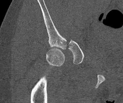 Acetabular Fracture Anterior Wall